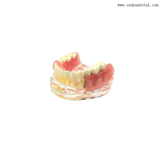 Сравнительная модель восстановления зубных имплантатов для обучения стоматологов