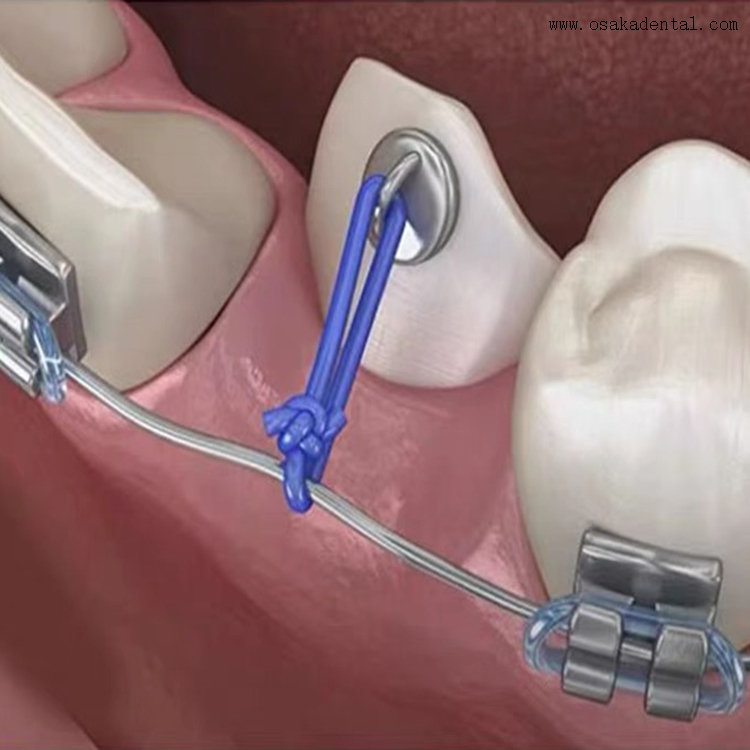 Стоматологические ортодонтические аксессуары Стоматологическая ортодонтическая резьба 25 футов 