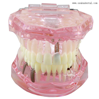 Модель зубного имплантата для обучения стоматолога