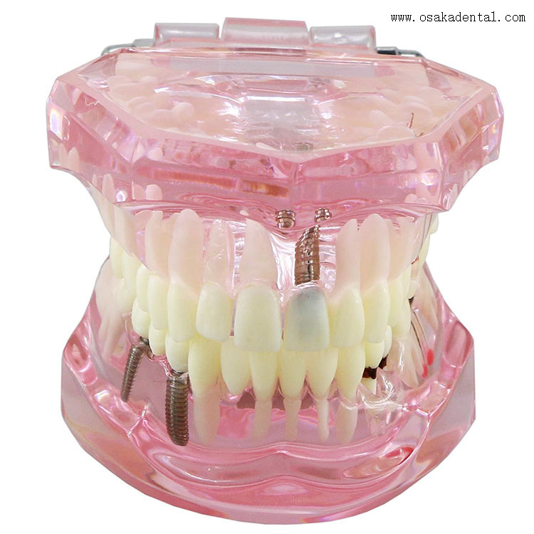 Модель зубного имплантата для обучения стоматолога